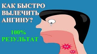 АНГИНА  как быстро ВЫЛЕЧИТЬ в домашних условиях Симптомы температура и антибиотики при ангине [upl. by Evania]