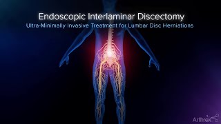 Interlaminar Approach to Disc Herniation Treatment [upl. by Arlina]