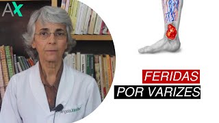 Feridas varicosas o que fazer 🤷‍♀️ [upl. by Brice]