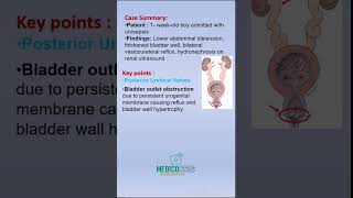 Posterior Urethral Valves  HighYield Renal Case for USMLE Step 1 usmlerecalls usmlestep1 [upl. by Melody]