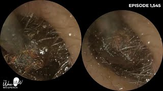 1545  Patient Still Felt Ear Was Blocked After Ear Wax Removal [upl. by Hailed]