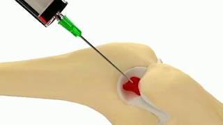 Elbow Olecranon Fossa Injection [upl. by Adnirb692]