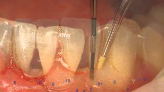 Laser Gum Surgery Before and After LANAP with XRays in Los Angeles [upl. by Enirbas]