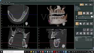 CBCT SOFTWARE DEMONSTRATION [upl. by Kovacs492]