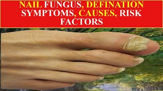 nail fungus What is nail fungs toe nail fungus [upl. by Oletha]