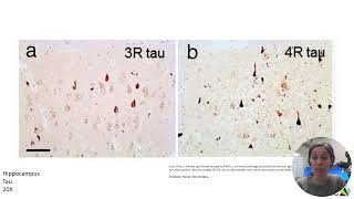 Neuropathology  Part 2 [upl. by Eldnik]