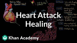 Healing after a heart attack myocardial infarction  NCLEXRN  Khan Academy [upl. by Kreda316]