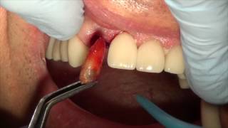 pulling tooth with implant placement in aesthetic zone [upl. by Nosmoht252]