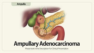 Ampullary Adenocarcinoma [upl. by Freya]