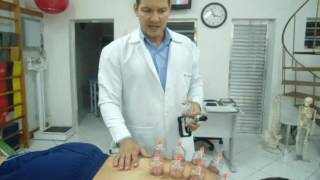 Fibromialgia  Ventosa  Ventosaterapia parte1 Clínica de Fisioterapia Dr Robson Sitta [upl. by Ahsirt125]