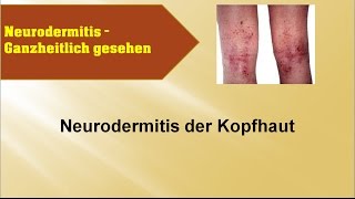 Neurodermitis der Kopfhaut  GANZMEDIZIN Naturheilpraxis [upl. by Gadmann]