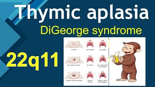 Thymic aplasia  DiGeorge Syndrome  USMLE Step 1 Immunology [upl. by Tully]