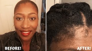 How To Regrow Edges And A Receding Hairline On Natural Hair Fast  Daily Care Routine 2020 [upl. by Alyson941]