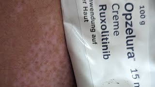 23 Tage Anwendung Opzelura Ruxolitinib Vitiligo Creme  erste Ergebnisse [upl. by Haveman]