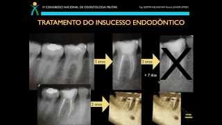 Diagnóstico e Tratamento do Insucesso em Endodontia [upl. by Reltuc993]