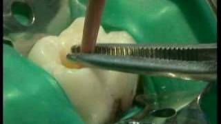 Endodontie mécanisée le système PROTAPER® principes et guide dutilisation [upl. by Llenor970]