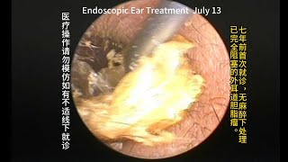 Re examination and cleaning of bilateral external auditory canal cholesteatoma after 7 years [upl. by Naida552]