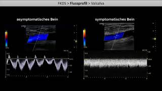 Kompressionssonographie der Beinvenen  Teil 2 Exkurs FKDS und Flussprofil [upl. by Pell71]