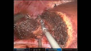 Simultaneous Robotic Right Colectomy with Intracorporeal Anastomosis and Partial Hepatectomy [upl. by Cressy797]