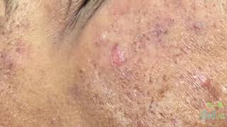 Black Head Extraction  Ezequiel  1st Treatment [upl. by Ellehsad]