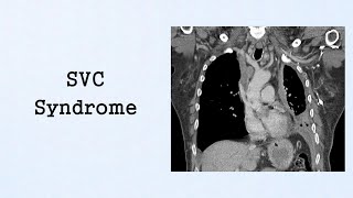 SVC Syndrome Oncologic Emergencies [upl. by Tobi704]