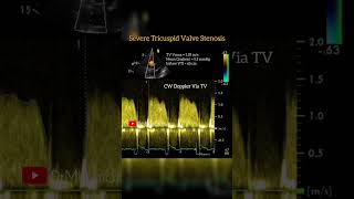 Tricuspid Valve Stenosis echocardiography cardiology [upl. by Byran]