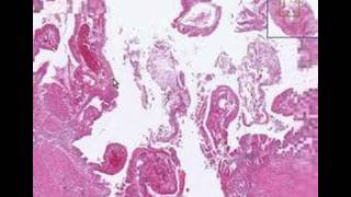 Histopathology GallbladderAcute cholecystitis [upl. by Aerdnas977]