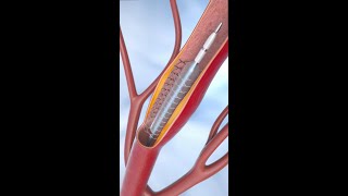 Coronary Angioplasty and Stent Insertion animation shorts anatomy science asmr [upl. by Claresta]