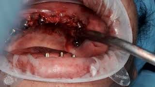 Upper full mouth suturing by using vicryl rapide [upl. by Trevorr461]