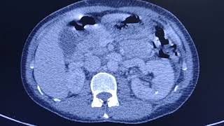 Acute pyelonephritis  CT findings [upl. by Yaresed]