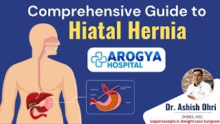 Comprehensive Guide to Hiatal Hernia  Types Symptoms and Treatment by Dr Ashish Ohri [upl. by Ahcsrop732]