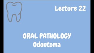 Odontoma Complete Lecture  For NBDE NDEB MDS amp FCPS [upl. by Nodrog185]