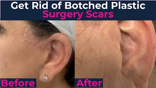 How to get rid of Botched Facelfit Scars [upl. by Ligetti449]