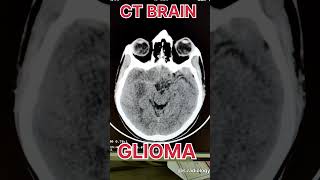 CT BRAIN GLIOMA [upl. by Nam]