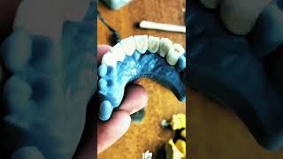 Upper interior ceramic crown ideal2 Dental Lab Pune [upl. by Moitoso]