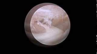 TMJ arthroscopic anatomy [upl. by Catima]