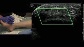 Ultrasound of the Dorsalis Pedis Artery [upl. by Aibonez]