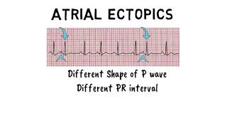 ATRIAL ECTOPICS [upl. by Burroughs]