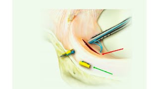 Meniscal Repair Getting It Right First Time [upl. by Florance763]