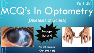 MCQs in Optometry  Diseases of Sclera  part 28 [upl. by Iadahs320]