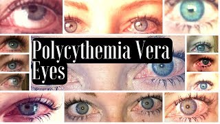 MPN Polycythemia Vera Blood Shot Red Eye Manifestations [upl. by Eimaraj]