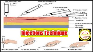 injection techniquesim injection subcutaneous injectionIntradermal injection [upl. by Yrruc906]