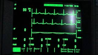 ECG  EKG paroxysmal supraventricular tachycardia holiday heart syndrome vs sick sinus syndrome [upl. by Beatriz]