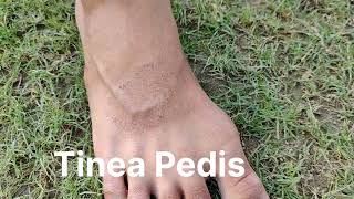 Tinea Pedis  Fungal Infection of Skin of Foot [upl. by Olive]