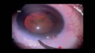 Phacoemulsification and zonular weakness  Supplementary video ID 212063 [upl. by Airetnohs708]