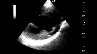 A video ultrasound scan of the heart beating [upl. by Chaddy285]