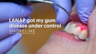 Treat periodontal disease with less pain Dr Urbanski explains the LANAP procedure [upl. by Ellita]