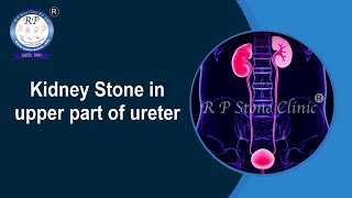 Kidney Stone in upper ureter Animation  Kidney Stone [upl. by Harewood775]