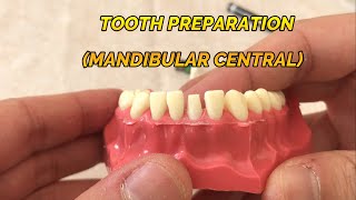 CROWN PREPARATION TUTORIAL MANDIBULAR CENTRAL [upl. by Loreen]