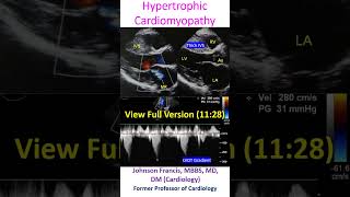 Hypertrophic Cardiomyopathy [upl. by Sumedocin]